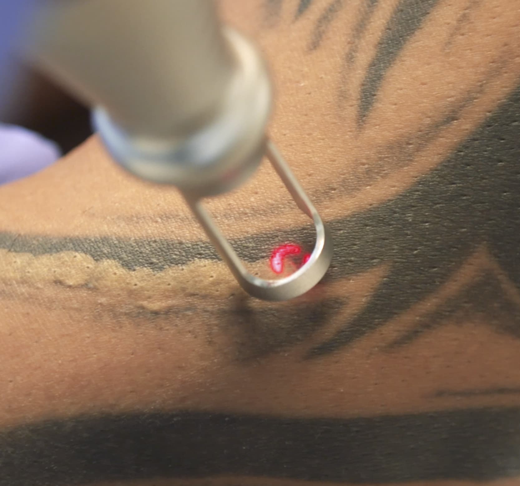 Citylaser Tattooentfernung mit dem Picoplus Laser