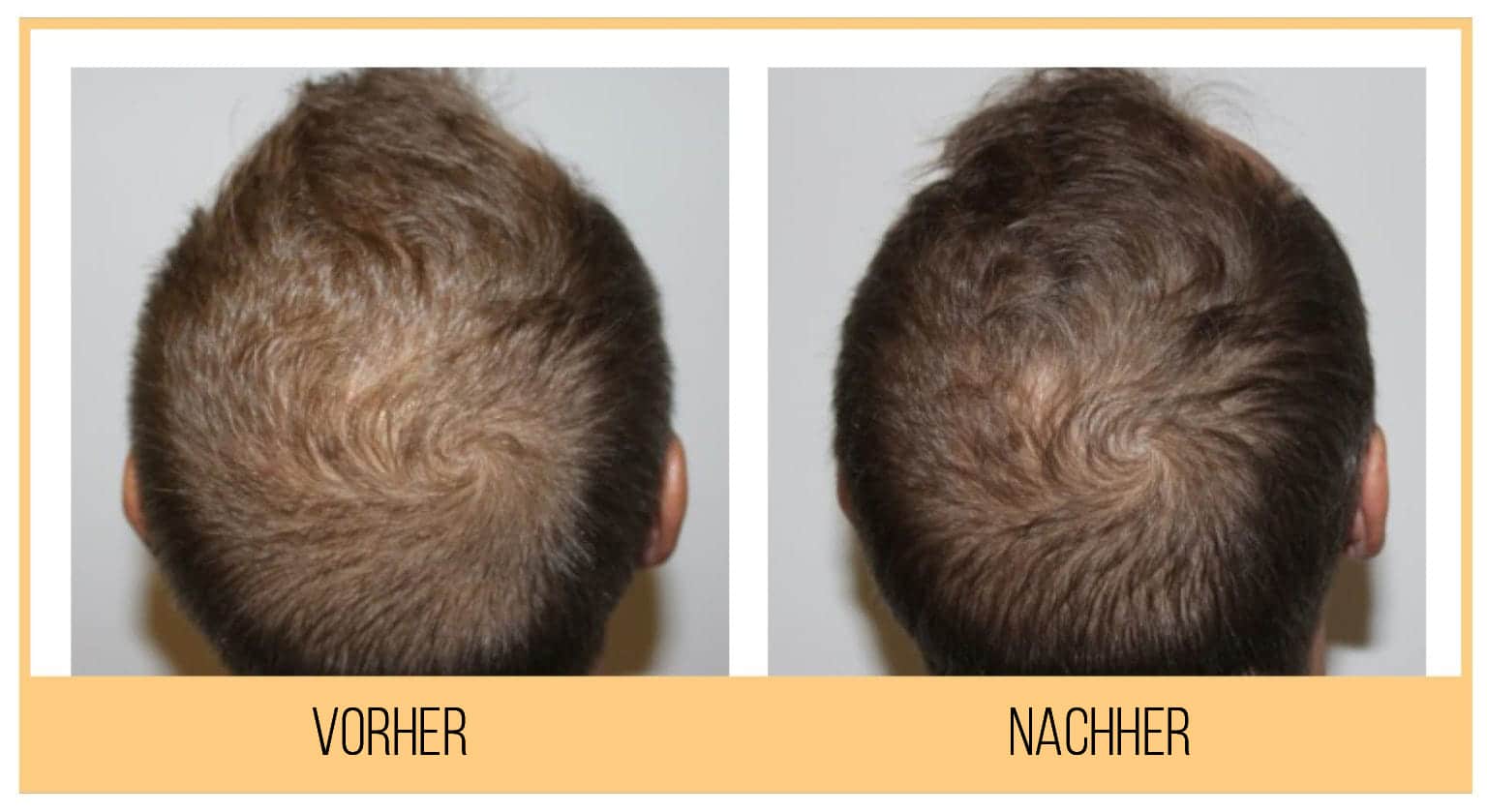 Hydrafacial Keravive Kopfhaut und Haare Citylaser