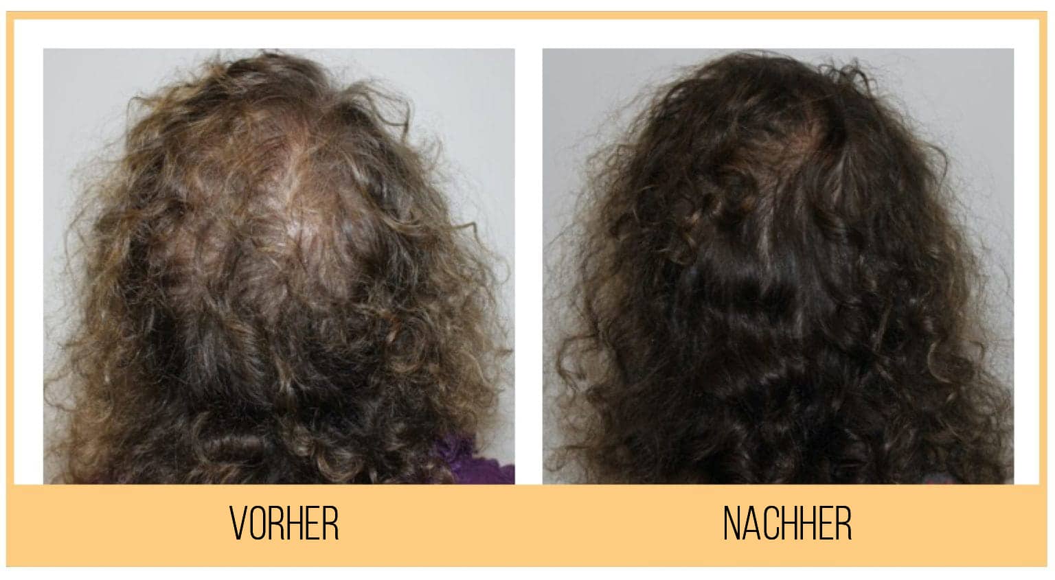 Hydrafacial Keravive Kopfhaut und Haare Citylaser